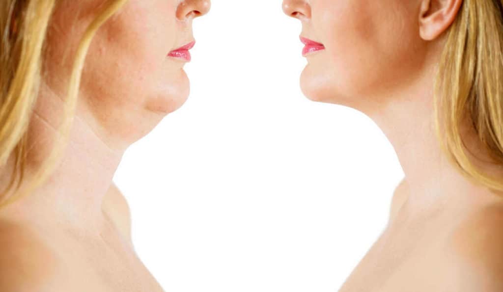 Double Chin treatment Greater London (Greenwich) before and after results