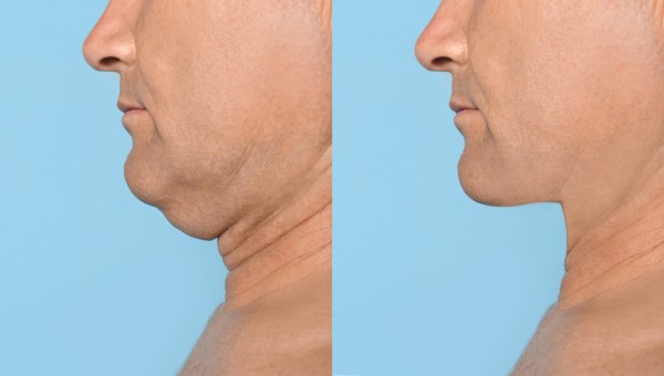 Which Non-Surgical Treatments Work Best for Jowls and Loose Skin Greater London (Greenwich)?
