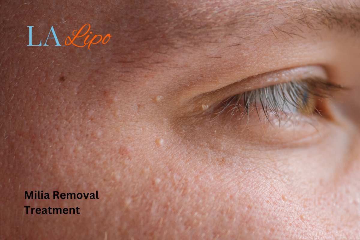 Cryopen Milia Removal: Is It the Easiest and Safest Option Greater London (Greenwich)?