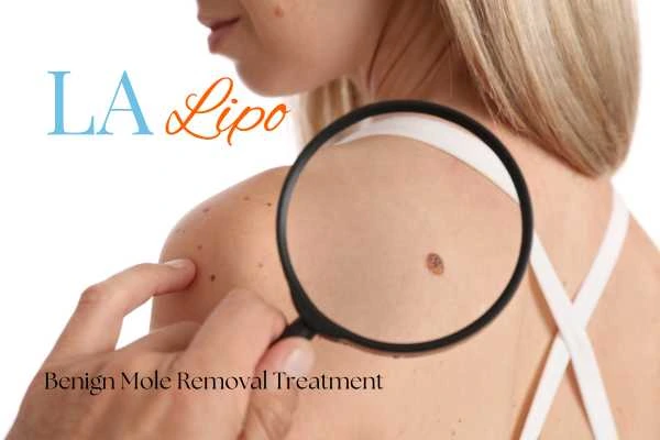 Woman having her inspection of blemish before mole removal Greater London (Greenwich)
