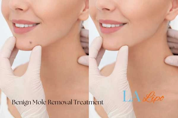 Before and after mole removal Greater London (Greenwich) treatment