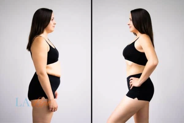 image of woman before and after results of LA-EMS Body Sculpting Greater London (Greenwich) to help treat Diastasis recti