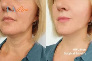hi-fu for wrinkles Greater London (Greenwich) before and after results