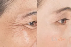 Before and after results of woman - HI-fu wrinkles reduction treatment Greater London (Greenwich)