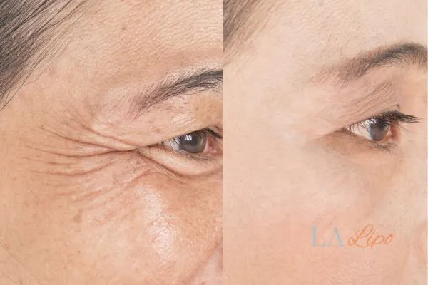 Before and after results of woman - HI-fu wrinkles reduction treatment Greater London (Greenwich)