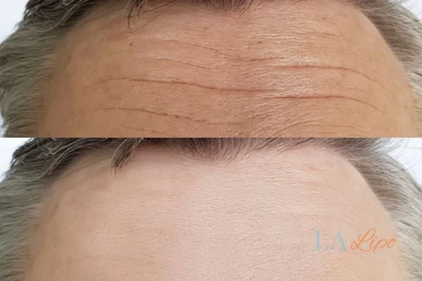 results of HIFU Greater London (Greenwich) on mans forehead to help reduce lines and wrinkles