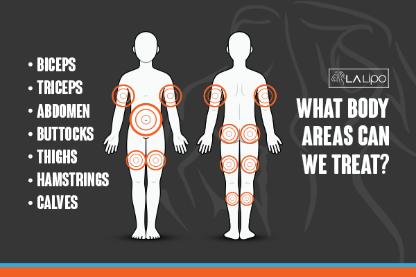 Graphic to show areas you can have LA-EMS Body Sculpting Greater London (Greenwich) treatment.