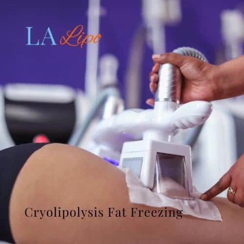fat freezing - Cryolipolysis Greater London (Greenwich)