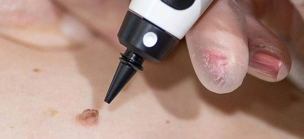 skin tag removal using cryopen Greater London (Greenwich)