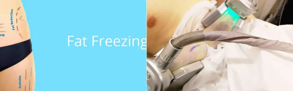 multi areas of a persons body having coolsculpting Greater London (Greenwich) treatment