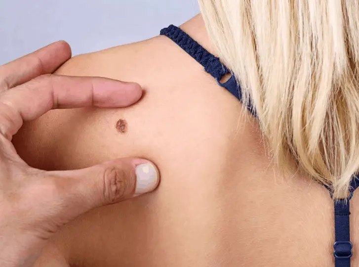 woman having mole removal Greater London (Greenwich) consultation before treatment.