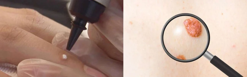 Person getting moles removed with cryopen Greater London (Greenwich)