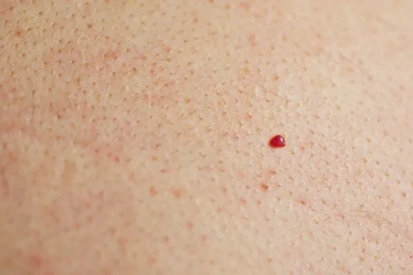 close up of a cherry angioma Greater London (Greenwich)