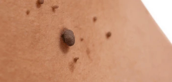 image of a skin tag Greater London (Greenwich)