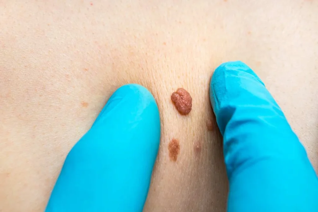Consultant examining a skin tag Greater London (Greenwich)