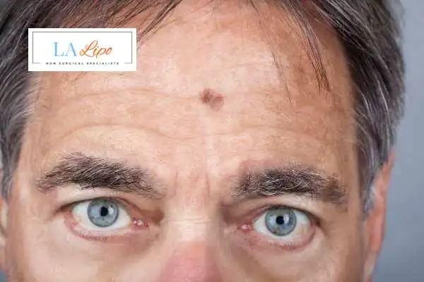Solar Lentigo Removal Greater London (Greenwich) image of man with mark on his forehead