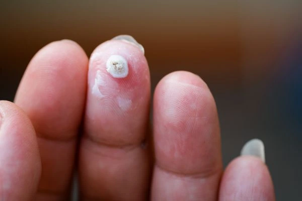wart on person finger - cryotherapy to treat from LA LIPO Greater London (Greenwich)