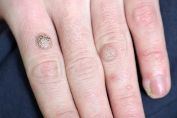 photo of warts on person hand - see wart removal Greater London (Greenwich) from LA LIPO
