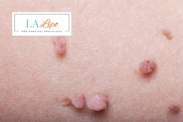 Does cryopen skin tag removal Greater London (Greenwich) hurt? Find out now call our team today!