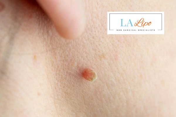 Book skin tag removal Greater London (Greenwich) today speak to our team now!