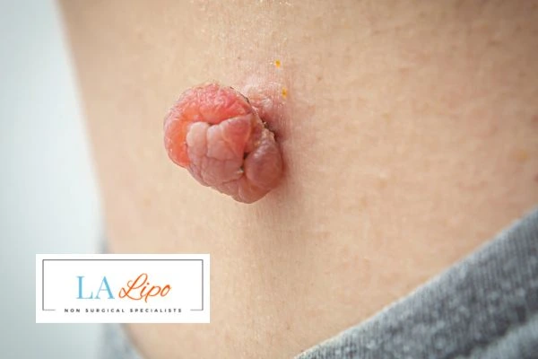 Interested in skin tag removal Greater London (Greenwich)? Concerned about the pain? Find out more today!