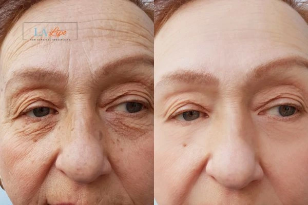 The powerful benefits of Morpheus8 Treatment Greater London (Greenwich) - Call Our team today!