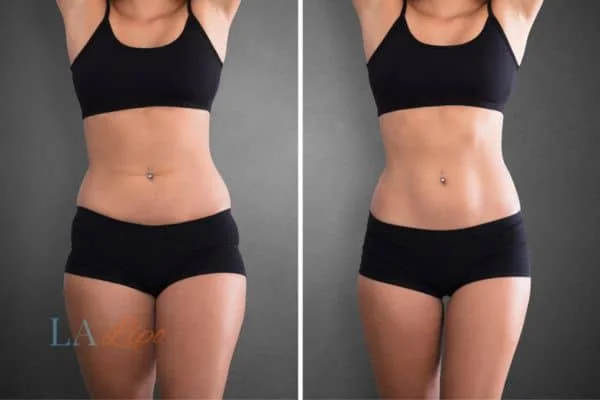 before and after results of non-surgical treatment to help a woman's body image and mental health Greater London (Greenwich)