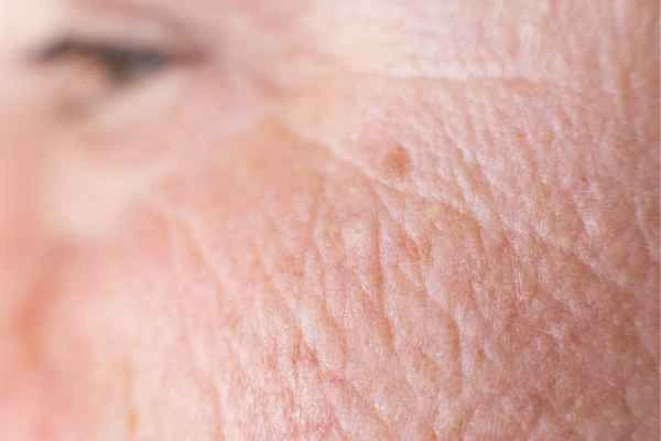 close up picture of a woman's face showing an age spot Greater London (Greenwich)