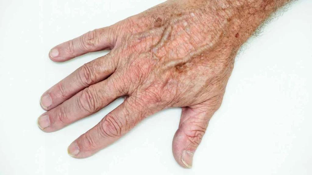 Male hand showing age spot Greater London (Greenwich)