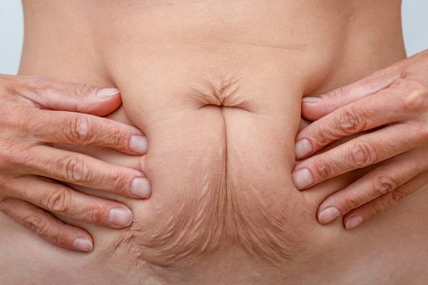 Image of a woman's stomach with loose skin - example of skin tightening Greater London (Greenwich) options