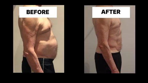 What Symptoms Can Diastasis Recti Cause in Men? Weak Core, Back Pain and Poor Posture Greater London (Greenwich)